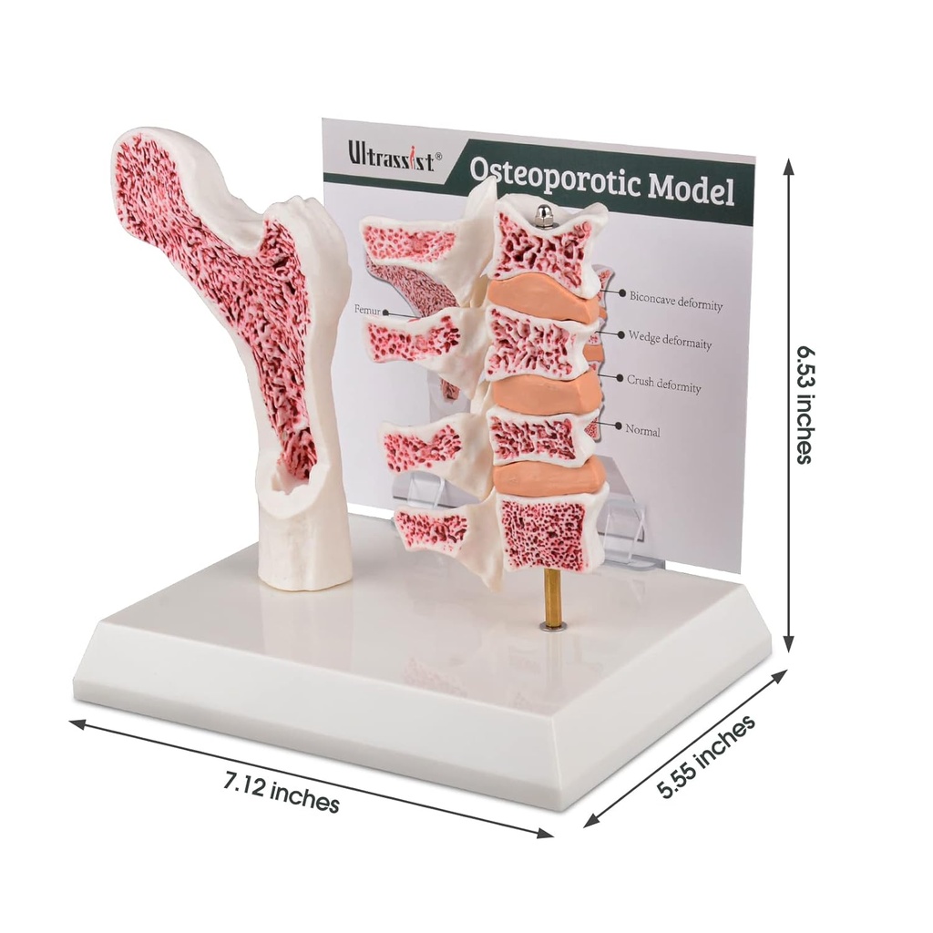 ultrassist-human-anatomy-osteoporosis-mo-6.jpg