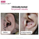 cica-glocalcare-clinically-proven-wound--6.jpg