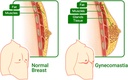gynecomastia-compress-patch---ginger-cre-3.jpg
