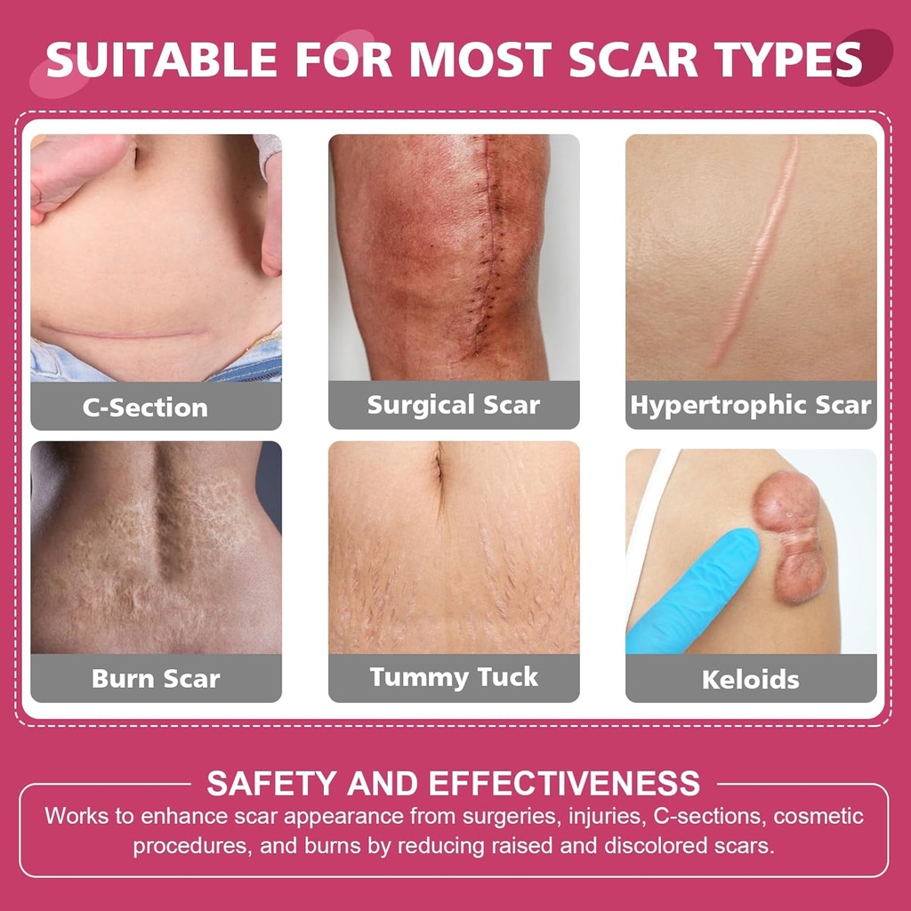 silicone-scar-sheetssilicone-scar-tape-f-2.jpg