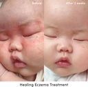 evereden-healing-eczema-treatment-17-fl--5.jpg