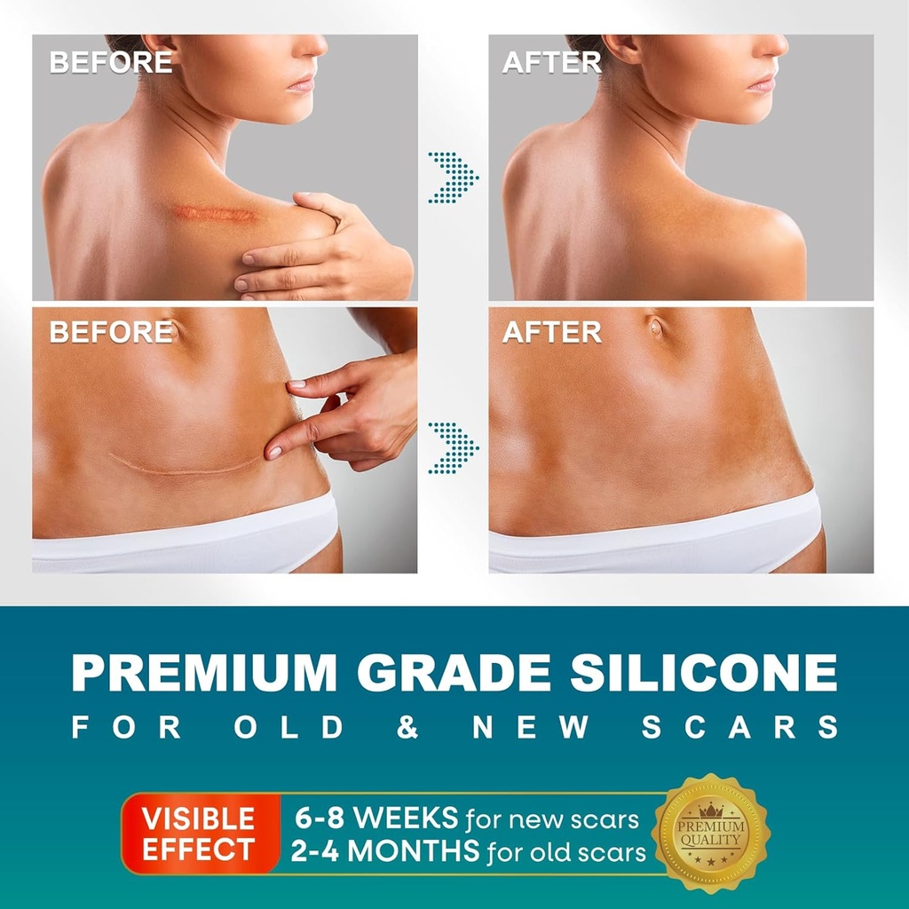 silicone-scar-sheets-silicone-scar-tape1-2.jpg