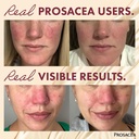 prosacea---medicated-rosacea-treatment-f-4.jpg