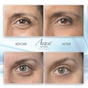 puffy-eye-gel-instant-results-naturally--3.jpg