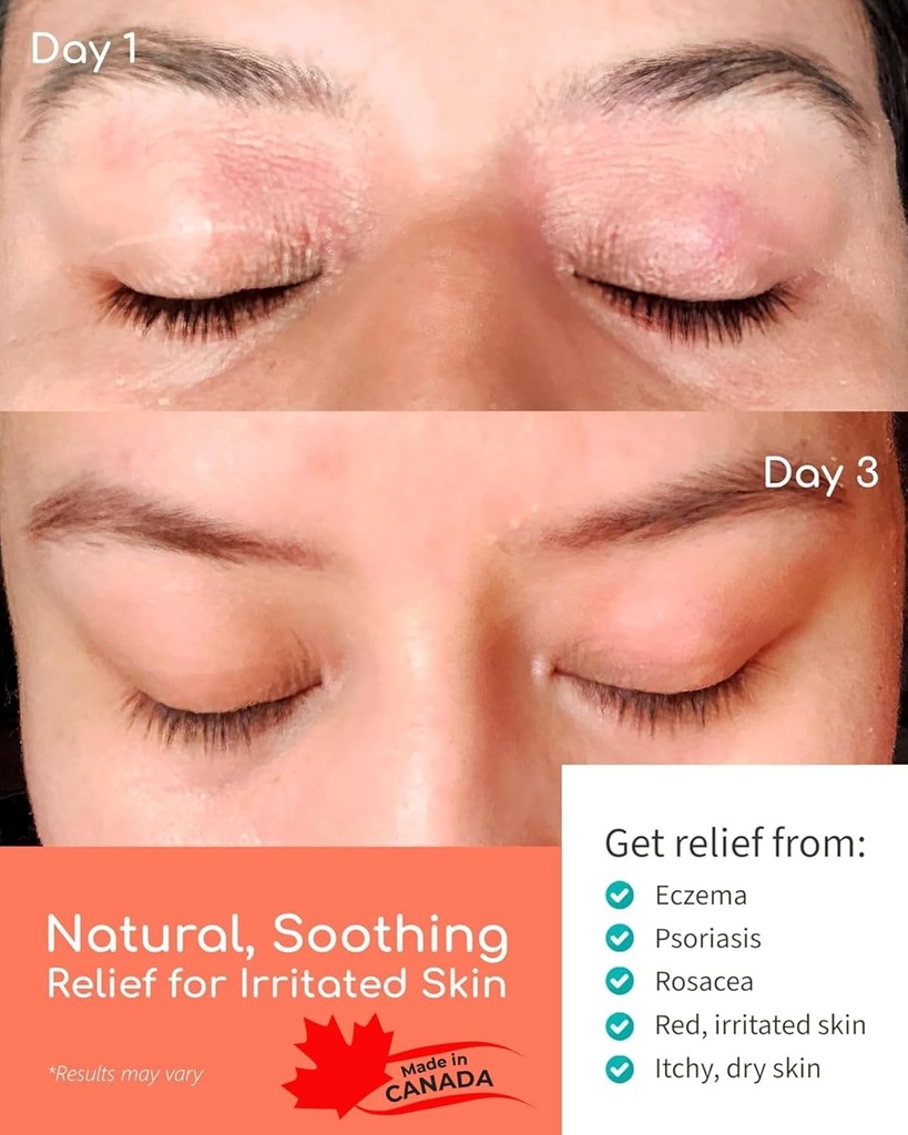 Organic Manuka Skin Soothing Cream for Sensitive Dry Skin, Original Formula, Itch Relief, Honey Eczema Relief, Natural Psoriasis Moisturizer & Dyshidrotic Eczema Balm for Face and Body (4 OZ) 4