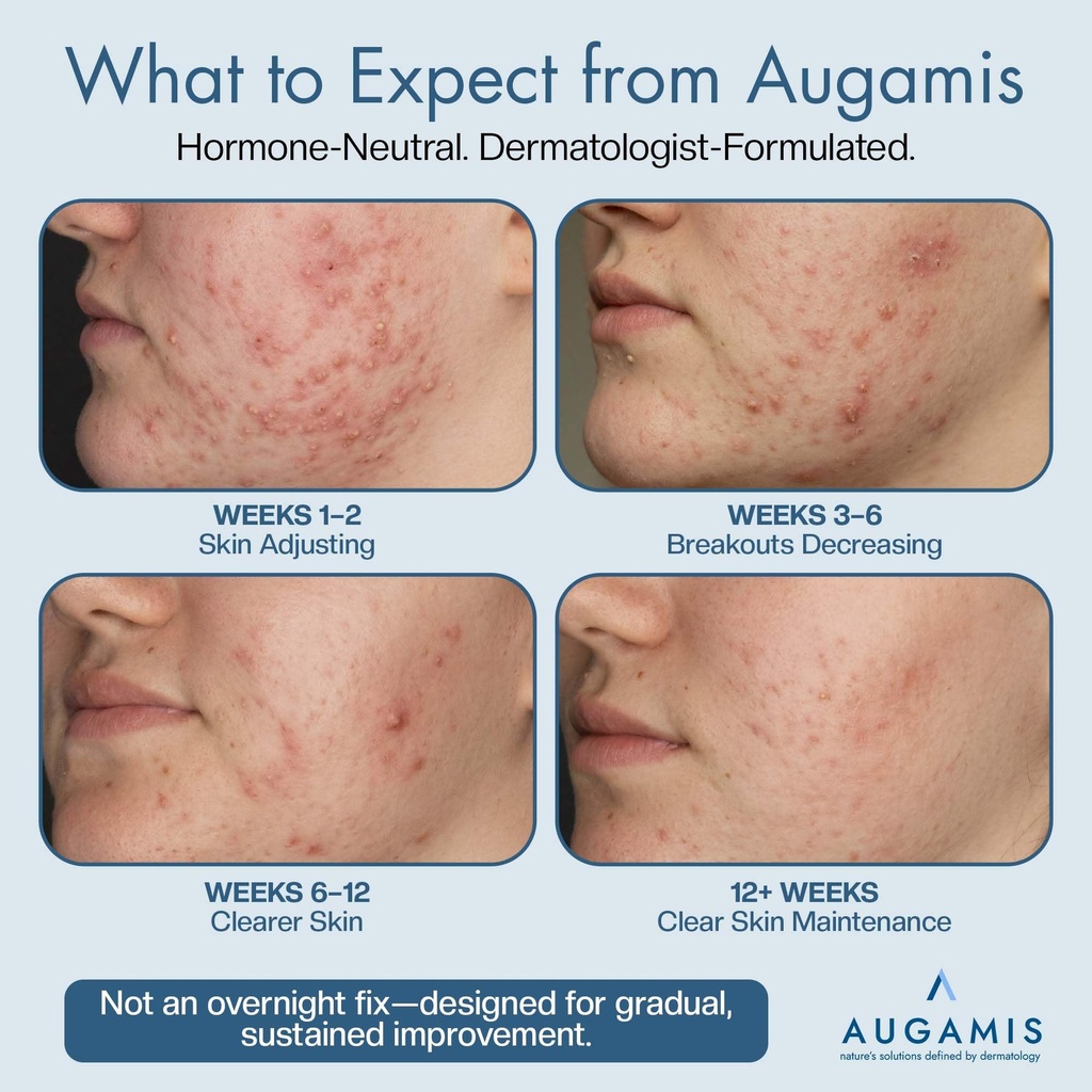 hormonal-acne-treatment-for-women-no-dim-2.jpg