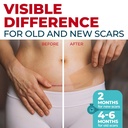 medical-grade-silicone-scar-tape-1-6-x15-2.jpg