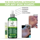 thyme-out-plus-eczema-treatment-psoriasi-2.jpg
