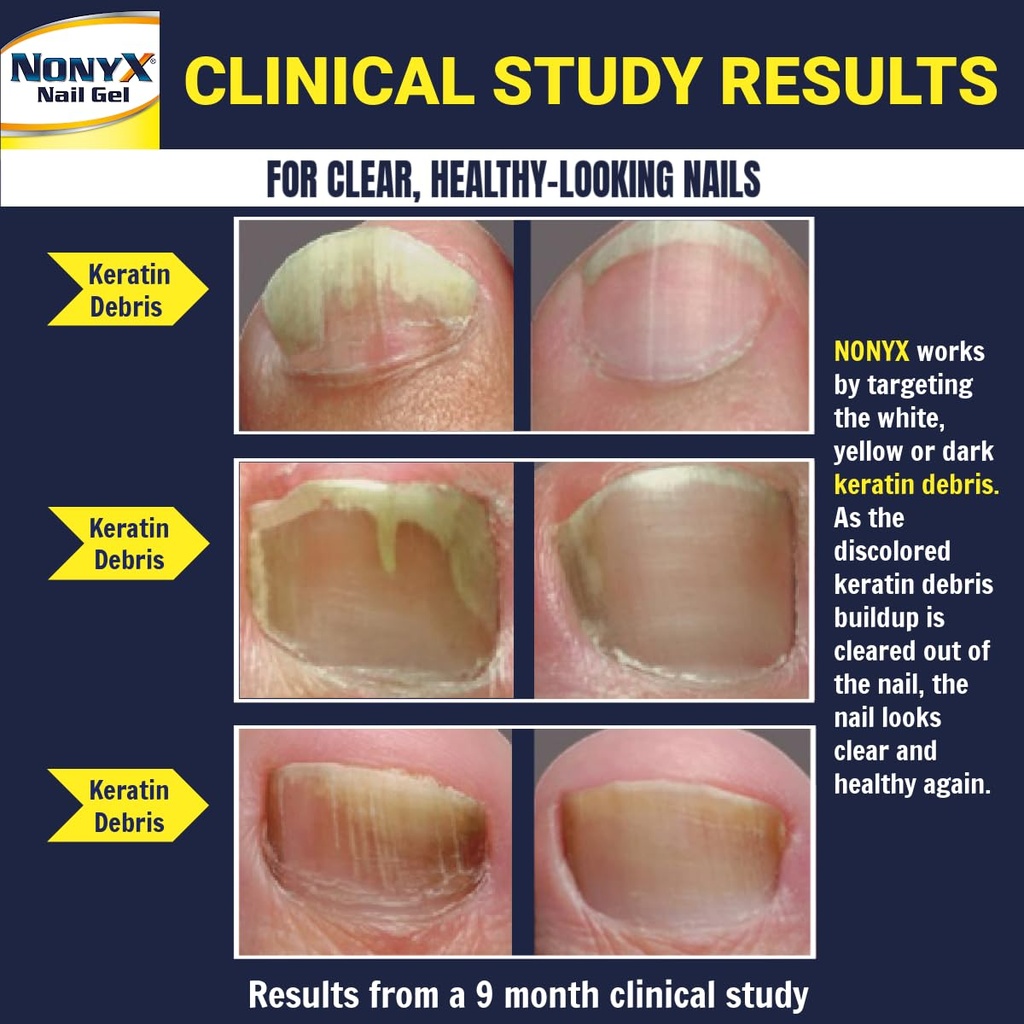 nonyx-fungal-nail-clarifying-gel-clinica-3.jpg