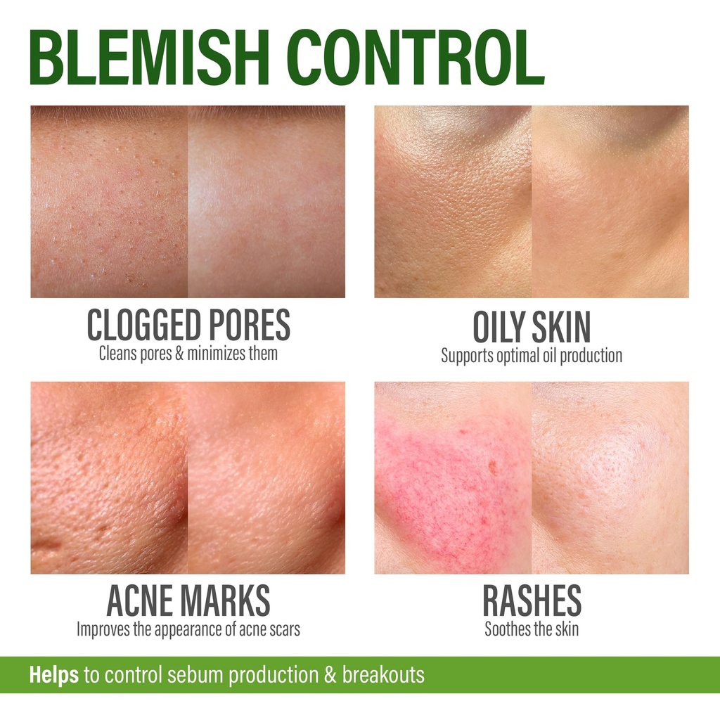 perfect-skin-acne-pills-clear-skin-suppl-4.jpg